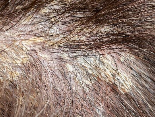 Sposób na swędzenie i łuszczenie skóry głowy